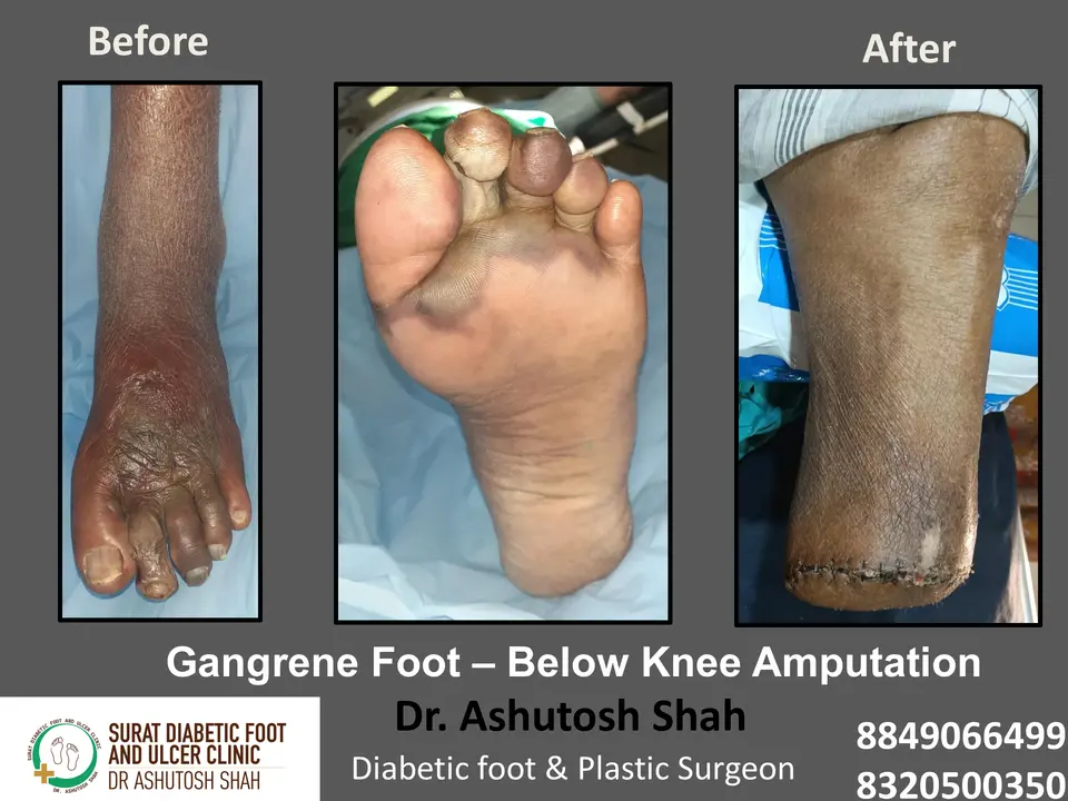 Diabetic Foot  PPT 3 checked by sir.pptx-17.webp